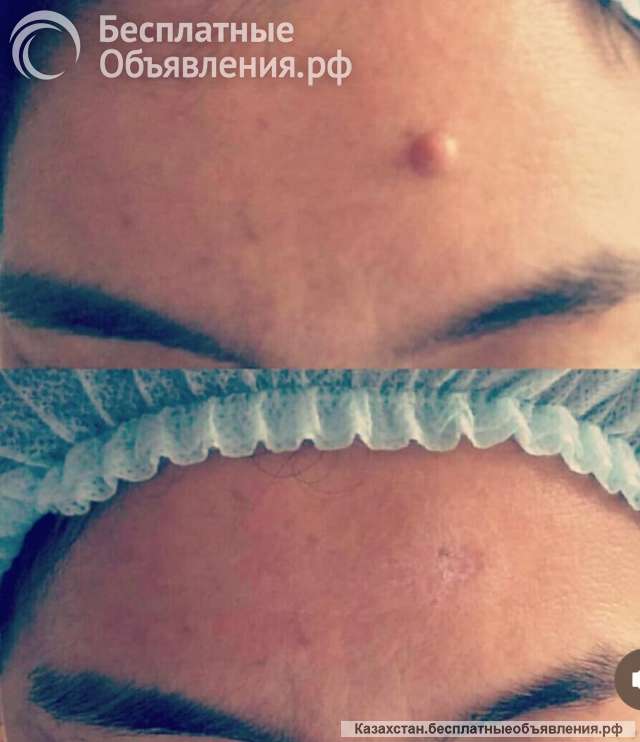 Лазерное удаление бородавок, родинок