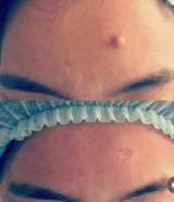Лазерное удаление бородавок, родинок