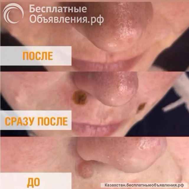 Лазерное удаление бородавок, родинок