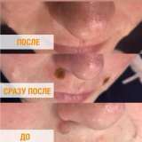 Лазерное удаление бородавок, родинок