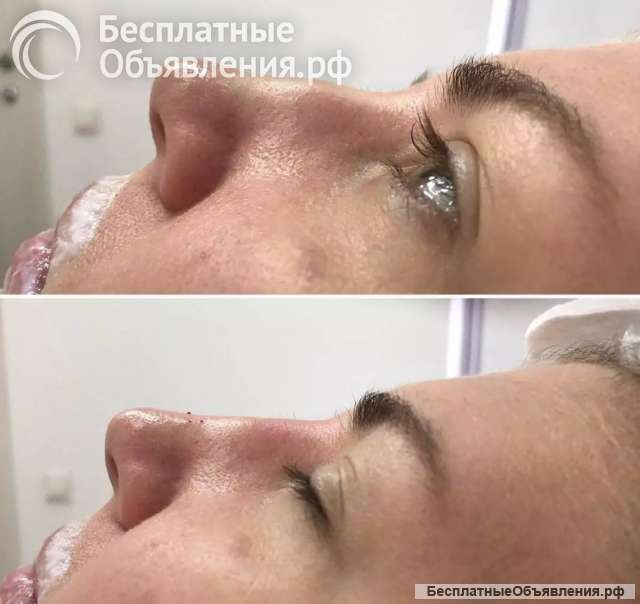 Коррекция носа филлером