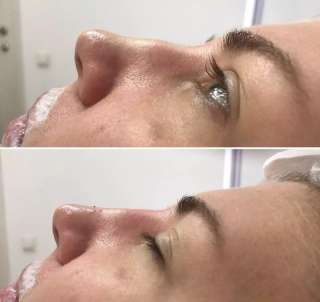 Коррекция носа филлером