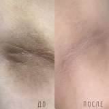 Косметолог / Чистка лица/ Пилинг/ Мезопилинг