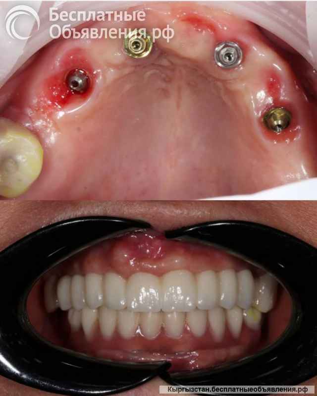 Скидки Металлокерамика, цирконий. Импланты Южная Корея