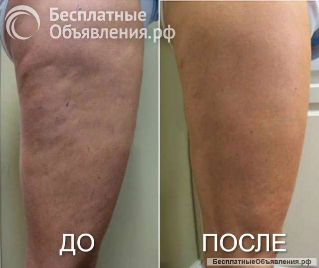 Массаж Антицеллюлитный, Классический, Огненный