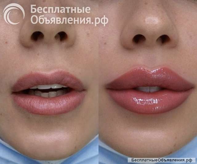 Увеличение губ, ботокс, Джоли, чистка лица