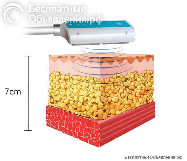 Криополиз - похудение без диет: уберём жировые клетки
