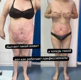 Экспресс похудение от -3 до -24см за 1 сеанс