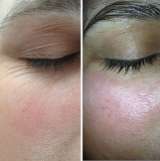 Массаж аппаратный вакуумный, кавитация, RF