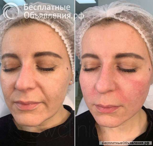 Чистка лица