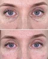 Чистка лица