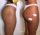 Чистка лица