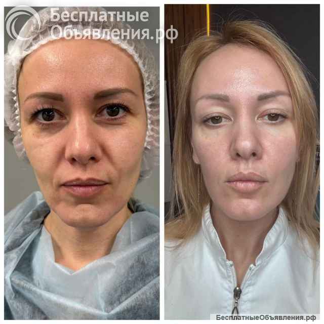 Чистка лица