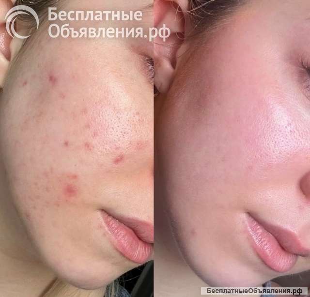 Пилинг 1000 вместо 3000