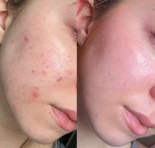 Пилинг 1000 вместо 3000