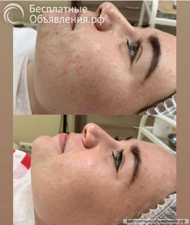 Пилинг 1000 вместо 3000