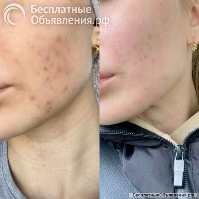 Пилинг 1000 вместо 3000