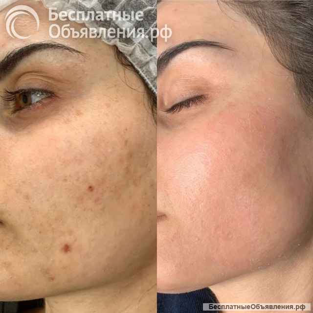 Пилинг 1000 вместо 3000