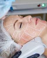 SMAS-лифтинг 8000 вместо 40 000