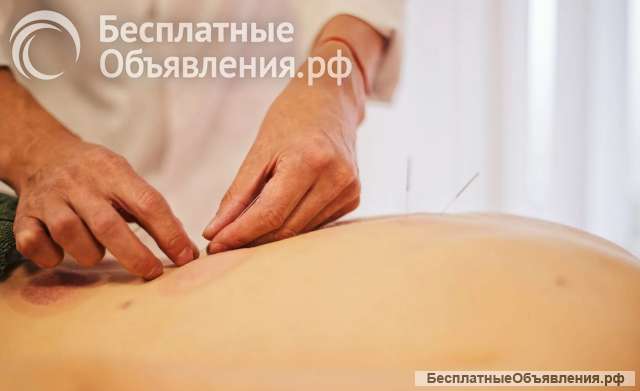 Иглоукалывание в Москве китайскими врачами цена
