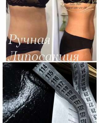 Ручная липосакция 5в1