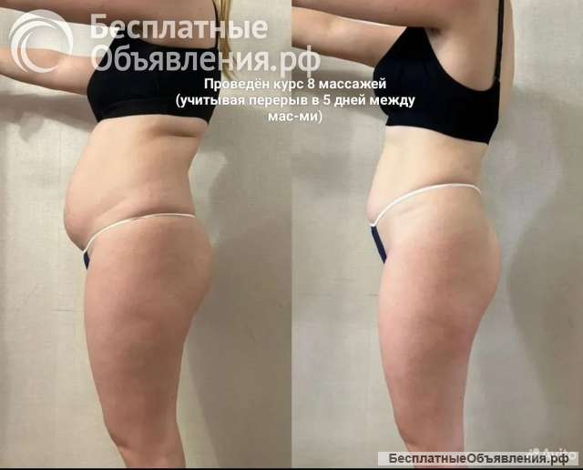 Ручная липосакция 5в1