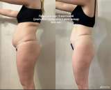 Ручная липосакция 5в1