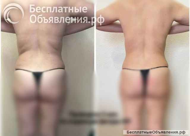 Ручная липосакция 5в1