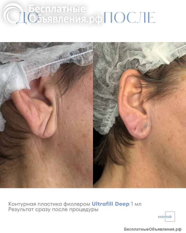 Ищем моделей на контурную пластику