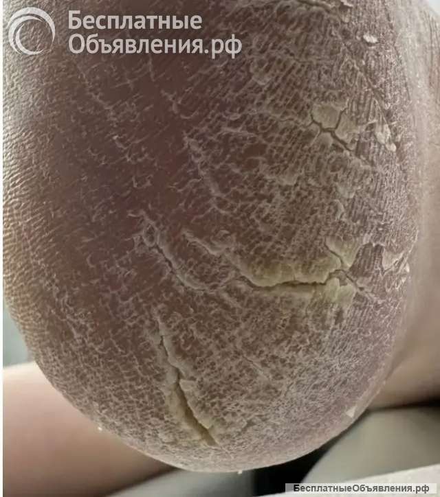 Подолог, педикюр