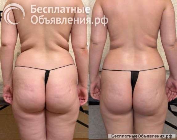 Аппаратный массаж по коррекции фигуры