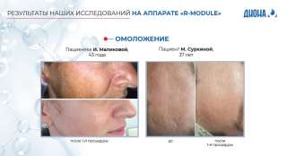 Аппарат косметологический СО2 с РУ