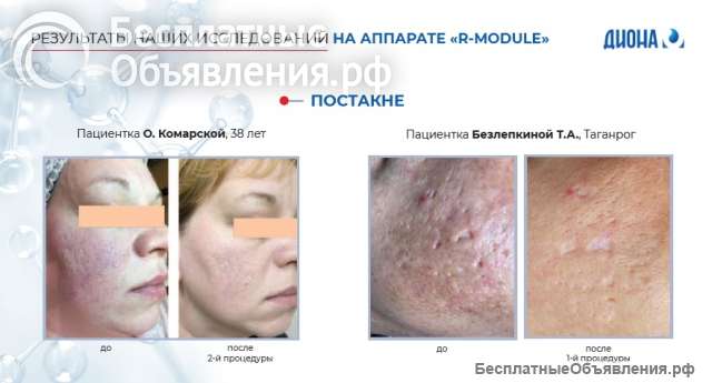 Аппарат косметологический СО2 с РУ