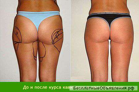 Коррекция фигуры