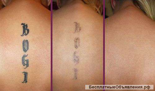 Лазерное удаление тату