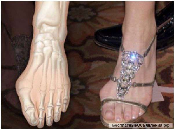 Бурсопротекторы для коррекции деформированного большого пальца