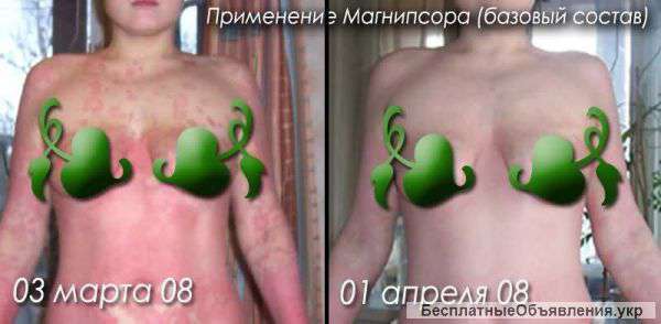 Псориаз мазь Магнипсор и масло черного тмина