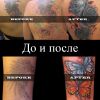 Удаление тату