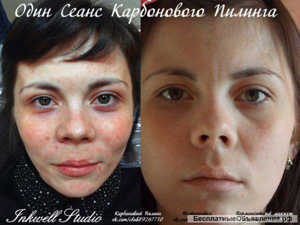 Карбоновый Пилинг