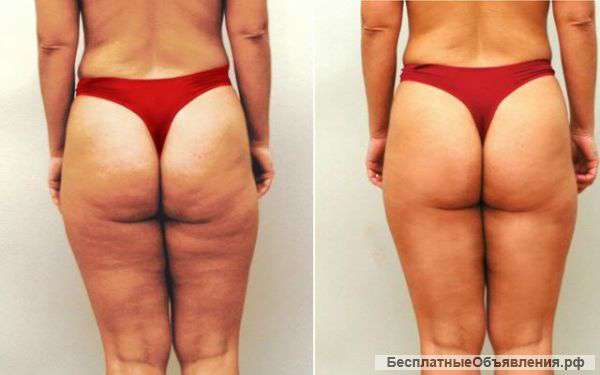 Массаж, обертывания