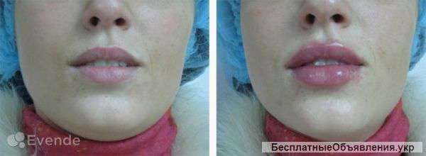 Контурная пластика губ