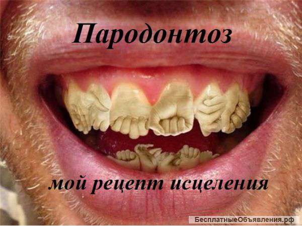 Пародонтоз-полное исцеление