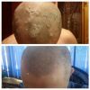 Эффективная помощь при псориазе, экземе, дерматите