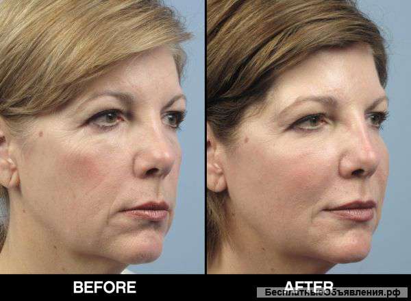 Биоревитализация - новый секрет вашей красоты