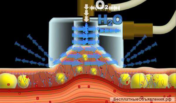 Аппаратный комплекс "Акваторнадо"