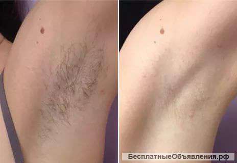 Шугаринг, биоэпиляция, сахарная эпиляция