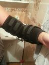 Лангетку(гипс) для перелома в логте