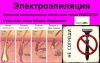 Электроэпиляция - удаление нежелательных волос всех типов навсегда с любого участка тела