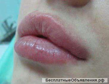 Контурная пластика , увеличение губ