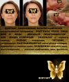 Омоложение подтяжка лица 1800 без операций лечение акне купероз прыщей миостимуляция